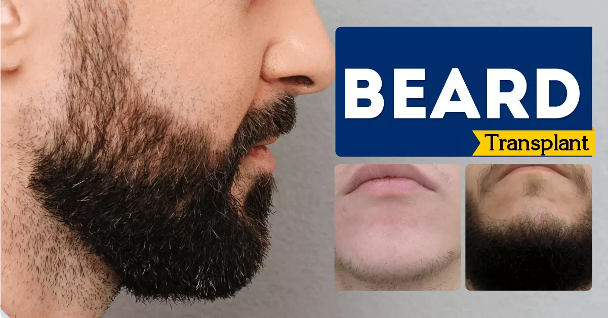 Beard-Transplant-Bangalore