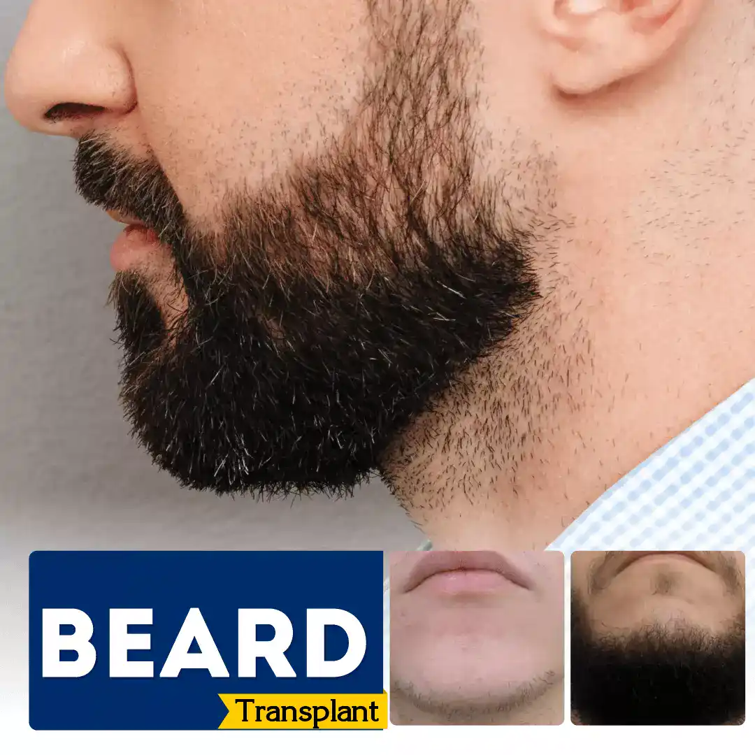 Beard-Transplant-Bangalore