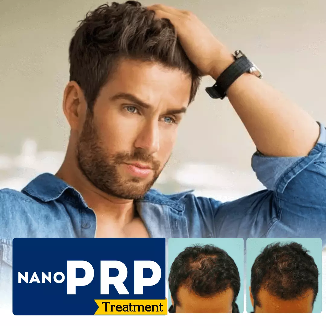 PRP-Hair-Care-Treatment-Bangalore