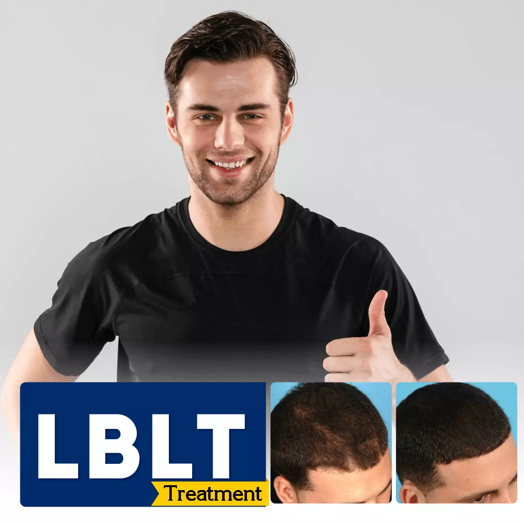 Laser-Hair-Treatment-Bangalore