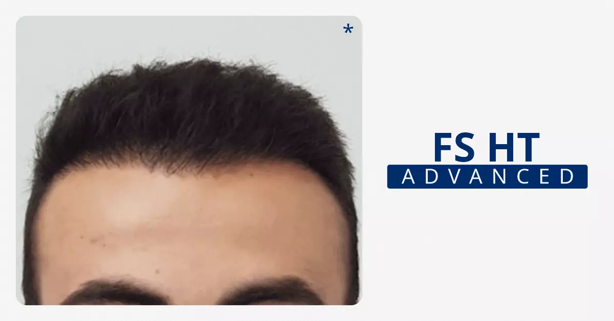 Best-Hair-Transplant-Bangalore