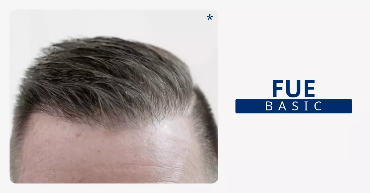 Fue-Hair-Transplant-Bangalore