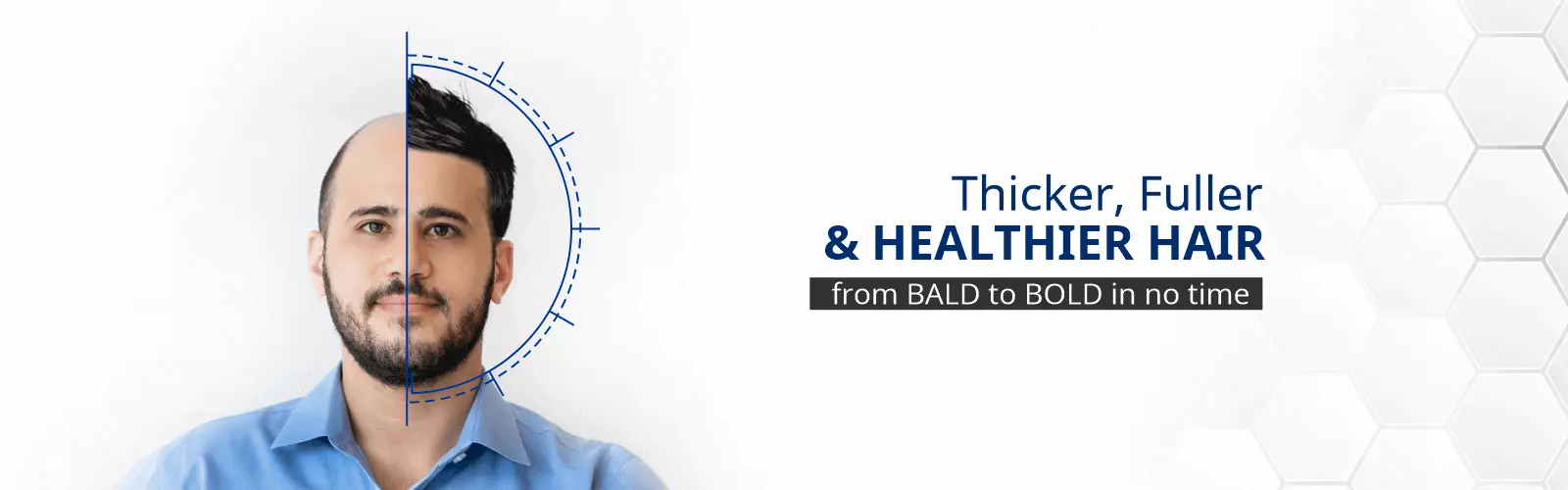 Fue-Hair-Transplant-Clinic-Bangalore-S