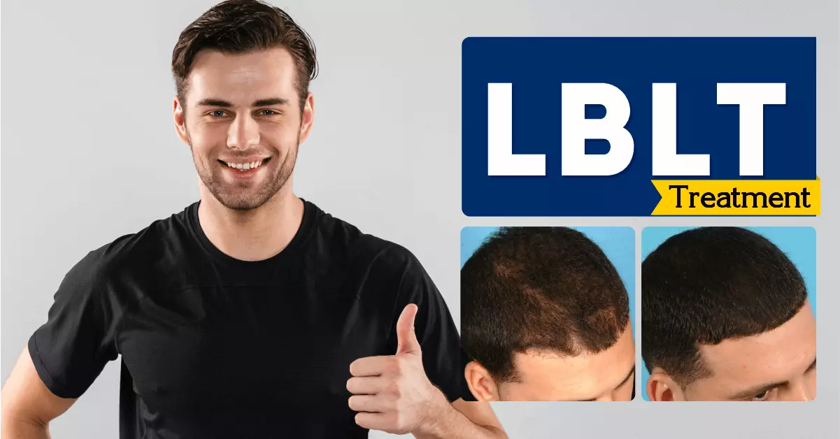 Laser-Hair-Treatment-Bangalore