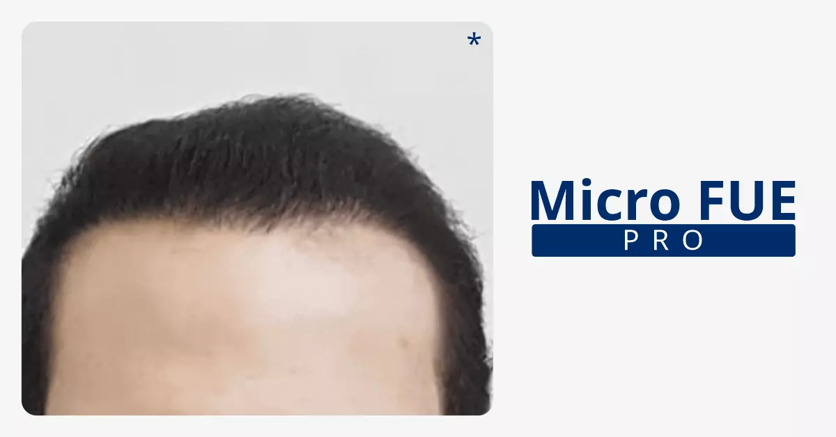 Micro-Fue-Bangalore